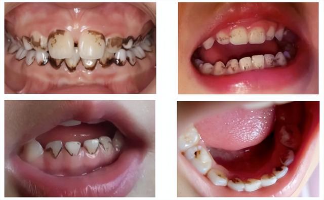 儿童牙齿有黑色污垢怎么去除补牙（儿童牙齿有黑色污垢怎么去除牙结石）